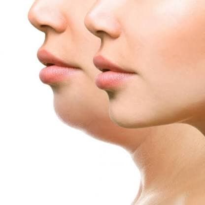 Chin & Jawline Sculpting at Bayou Glow, LLC in Larose, LA